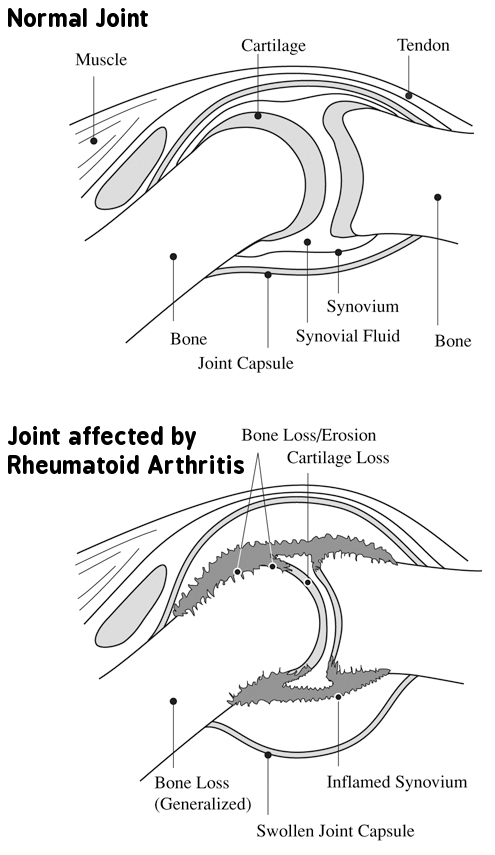 Rheumatoid Arthritis joint