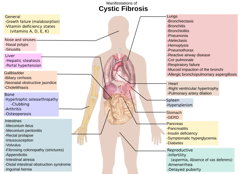 Image result for manifestation of cystic fibrosis