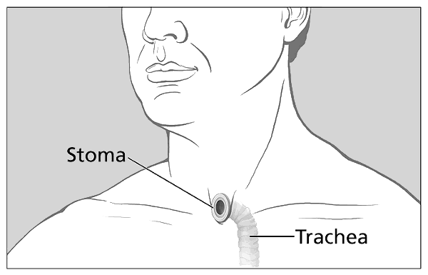 Trachea with Stoma