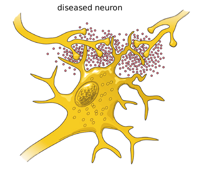 neuron diseased