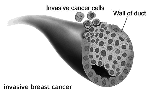 Image result for Invasive Breast Cancer