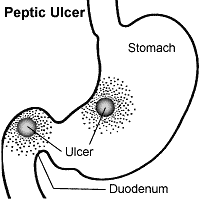 Peptic Ulcer