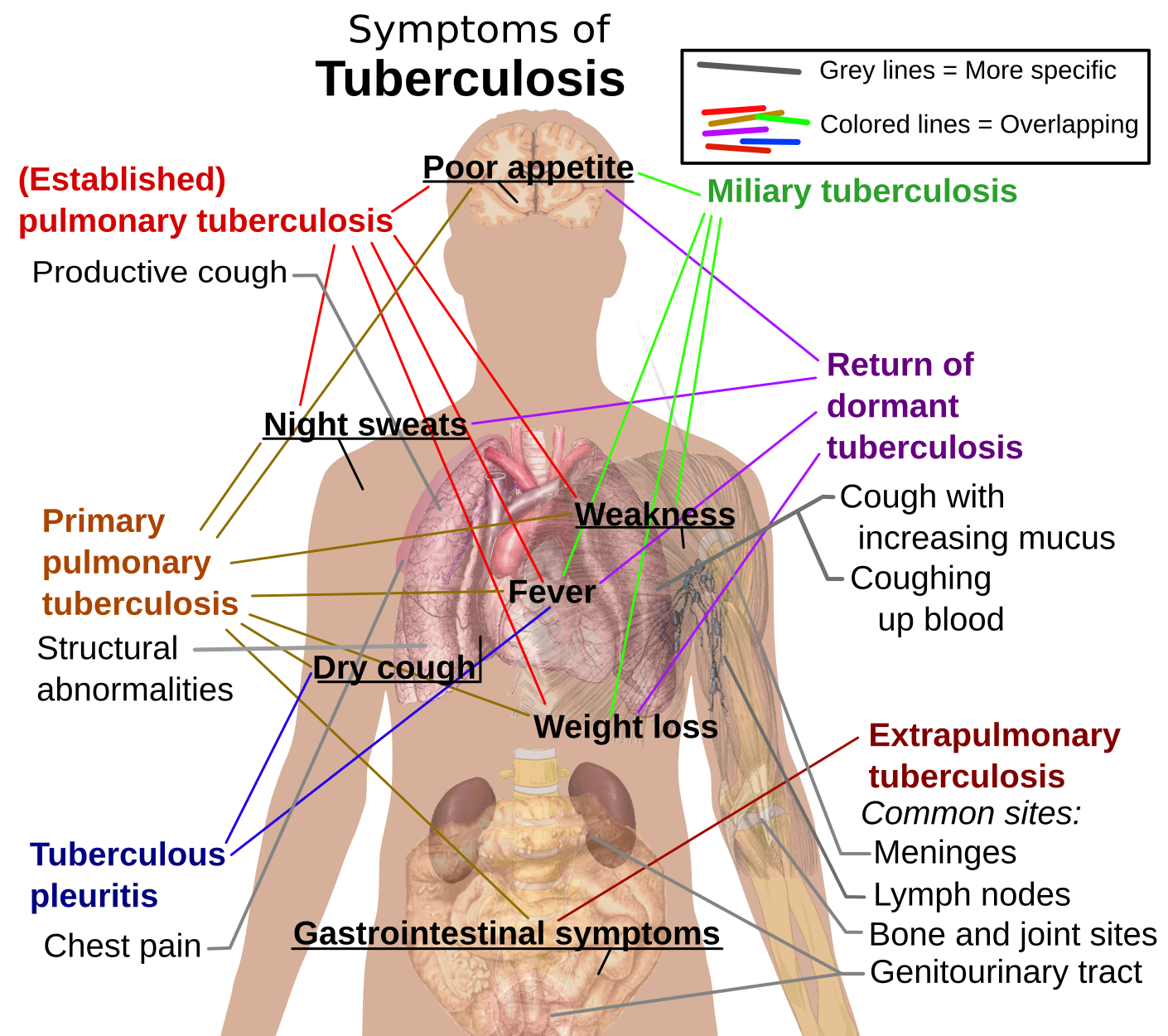 Tuberculosis symptoms