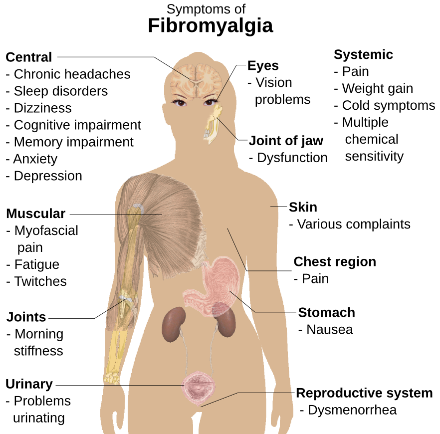 fibromyalgia symptoms