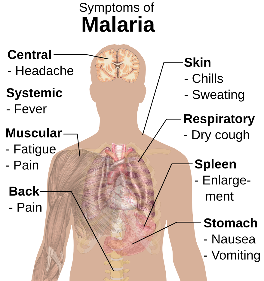Malaria symptoms