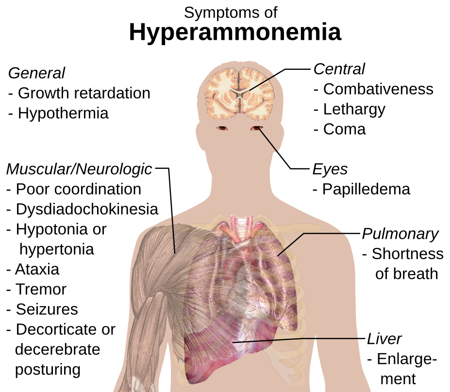 hyperammonemia symptoms